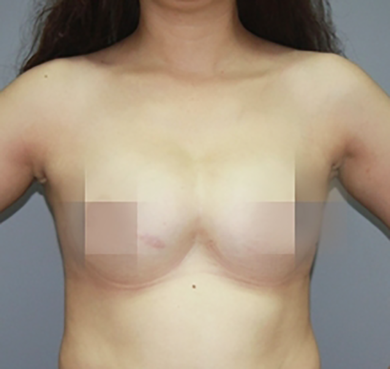 Ngực bị dính liền - Dr.Hiếu Liêm Q.10