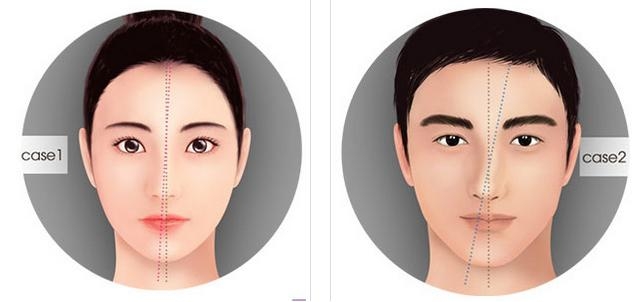 Mũi bị vẹo và không cân đối - Dr.Hiếu Liêm Q.10