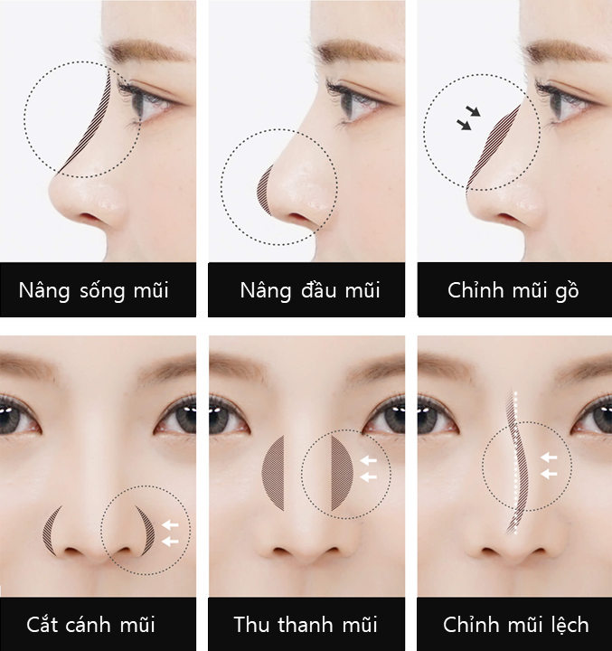 Nâng mũi cấu trúc dựng trụ - Dr. Hiếu Liêm Q.10