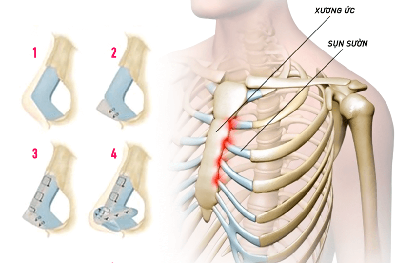 Nâng mũi cấu trúc sụn sườn có vĩnh viễn không - Dr.Hiếu Liêm Q.10
