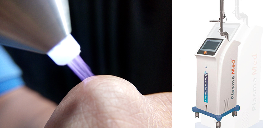 Công Nghệ Plasma nhiệt lạnh hạn chế sẹo thâm - Dr.Hiếu Liêm Q.10