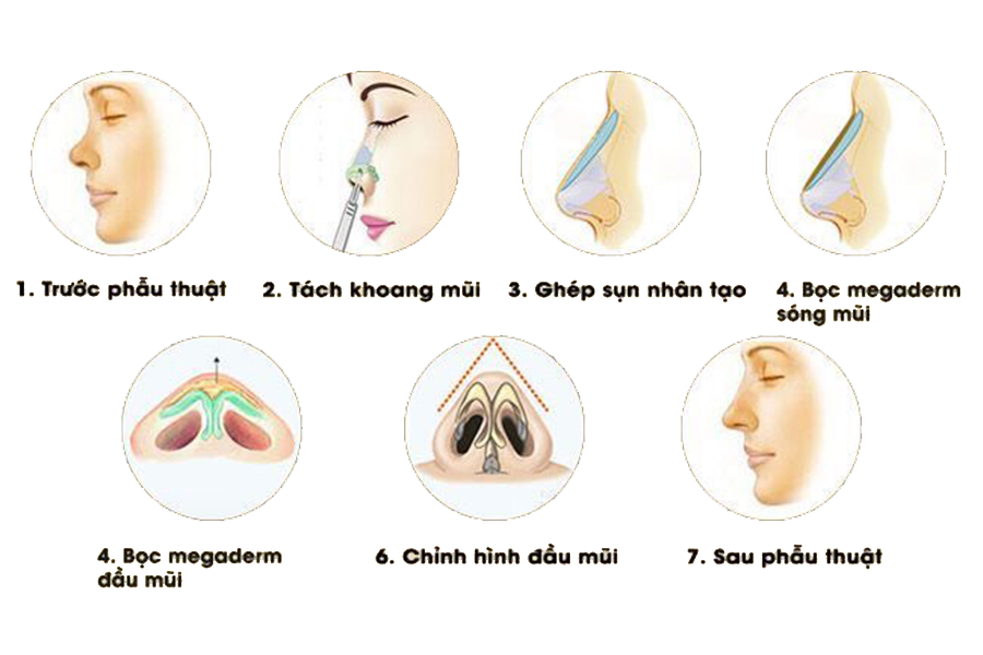 Nâng mũi dựng trụ - Dr.Hiếu Liêm Q.10