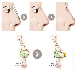 Nâng mũi ở nam giới - Dr.Hiếu Liêm Q.10
