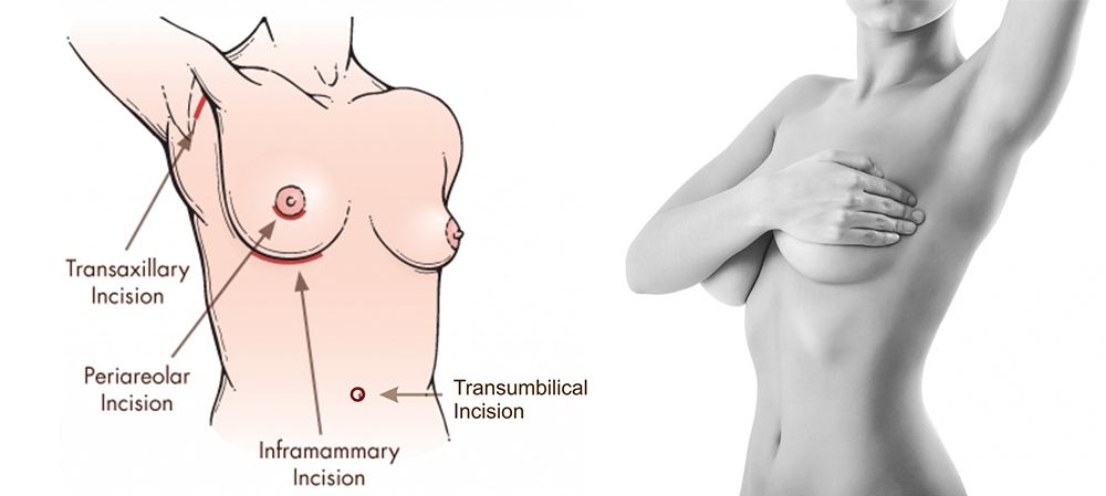 Nâng ngực đường nội soi - Dr.Hiếu Liêm Q.10