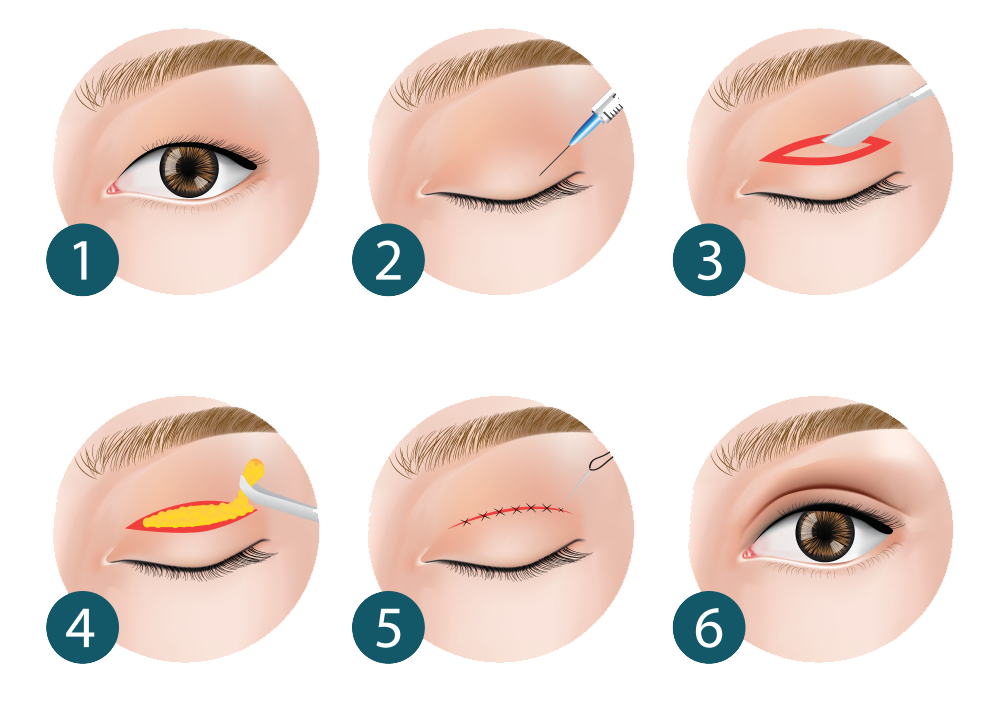 Phẫu thuật mắt mí - Dr.Hiếu Liêm Q.10