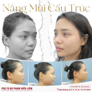 Nâng mũi cấu trúc cùng Dr.Hiếu Liêm Q.10