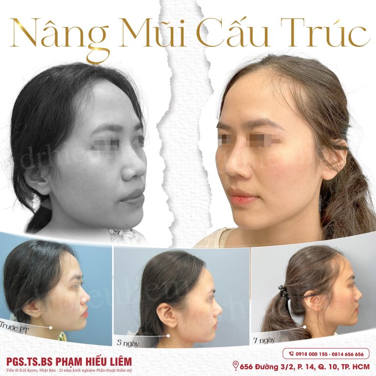 Nâng mũi cấu trúc cùng Dr.Hiếu Liêm Q.10