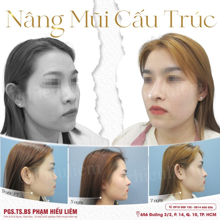 Nâng mũi cấu trúc cùng Dr.Hiếu Liêm Q.10