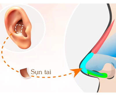 Đặt sụn tai bọc mũi - Dr.Hiếu Liêm Q.10