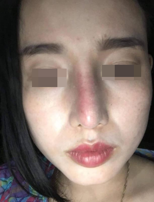 Sụn mũi bị hỏng - Dr.Hiếu Liêm Q.10
