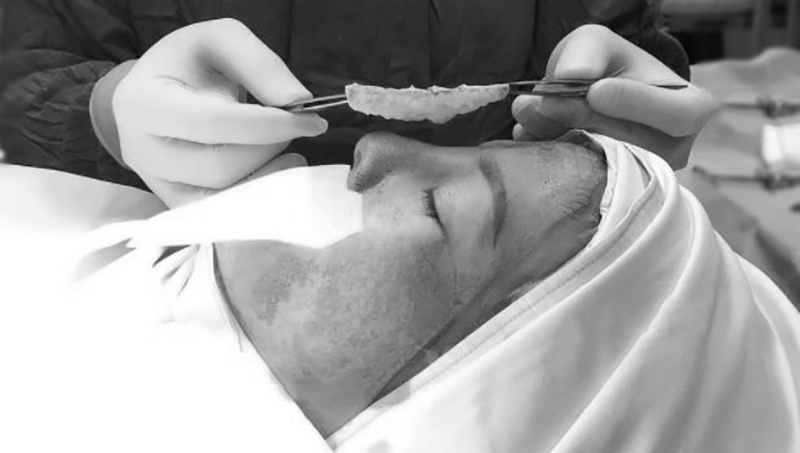 Nâng mũi bằng mỡ trung bì như thề nào - Dr.Hiếu Liêm Q.10