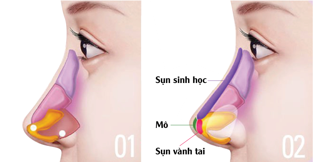 Nâng mũi có vĩnh viễn không - Dr.Hiếu Liêm Q.10