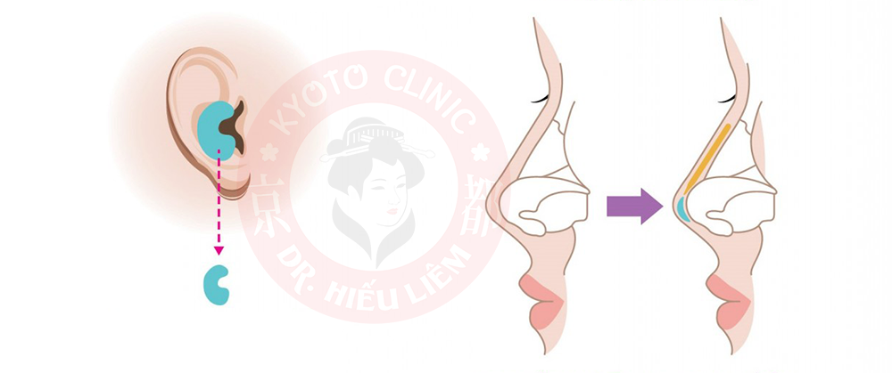 Nâng mũi bằng sụn tai có bị teo lại không - Dr.Hiêu Liêm Q.10
