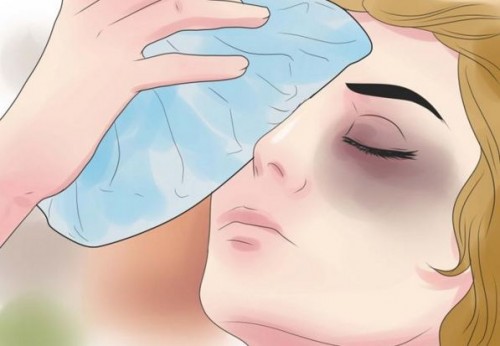 Nâng mũi bị sưng mắt - Dr.Hiếu Liêm Q.10