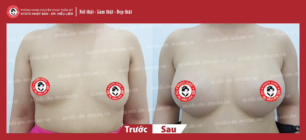 hinh-anh-khach-hang-kim-chi-nang-nguc-bac-si-hieu-liem