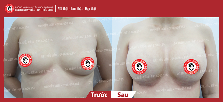 hinh-anh-khach-hang-nang-nguc-tui-don-Motiva-Ergonomix360-ngoc
