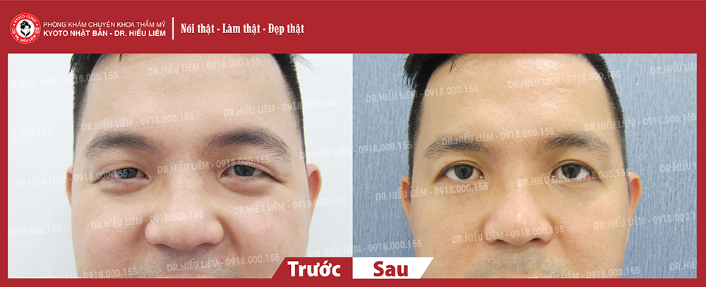 hinh-khach-nhan-mi-treo-cung-chan-may-ten-trung