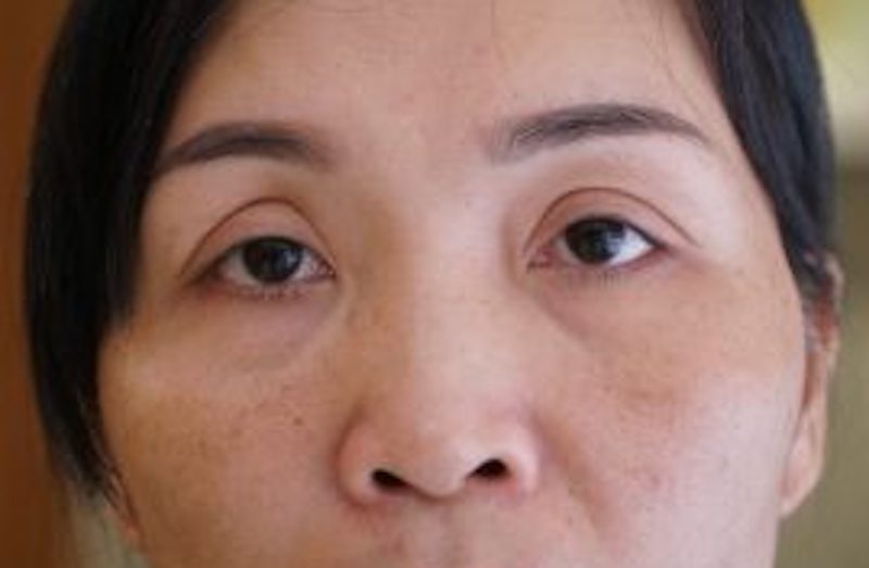 Mí mắt quá to - Dr.Hiếu Liêm
