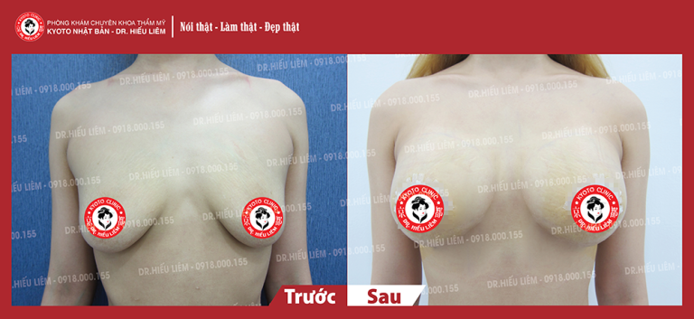 review-khach-hang-nang-nguc-treo-sa-tre-sau-1-nam-ut